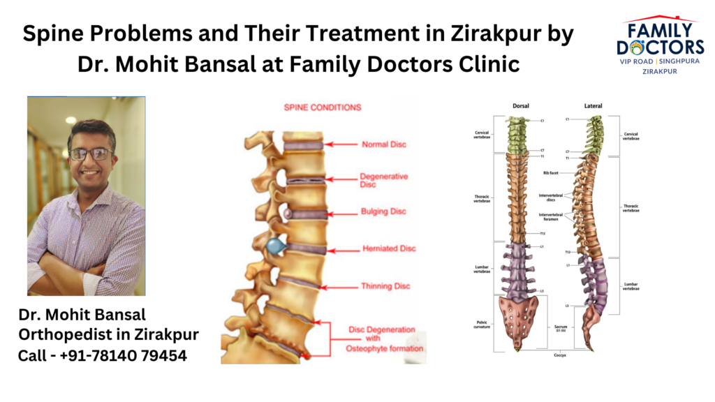 Spine Problems and Their Treatment in Zirakpur by Dr. Mohit Bansal at Family Doctors Clinic