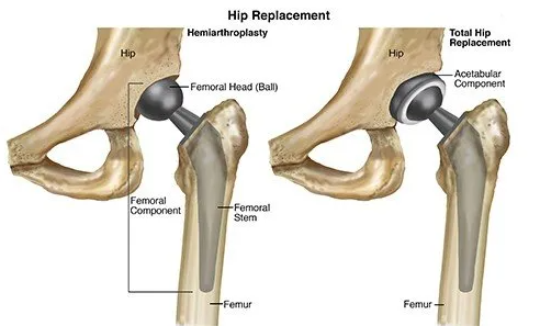 hip replacement surgeon
