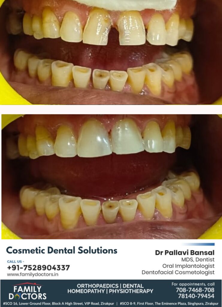 Cosmetic dental solutions