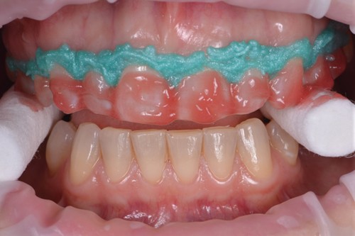 teeth whitening in zirakpur